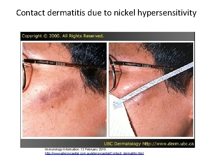 Contact dermatitis due to nickel hypersensitivity Zdroj obrázku: Allergy Capital: Contact dermatitis. Australian Allergy,