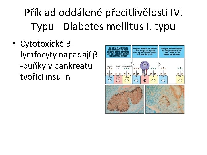 Příklad oddálené přecitlivělosti IV. Typu - Diabetes mellitus I. typu • Cytotoxické Blymfocyty napadají