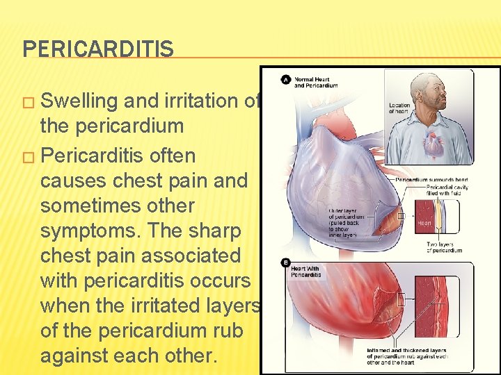 PERICARDITIS � Swelling and irritation of the pericardium � Pericarditis often causes chest pain