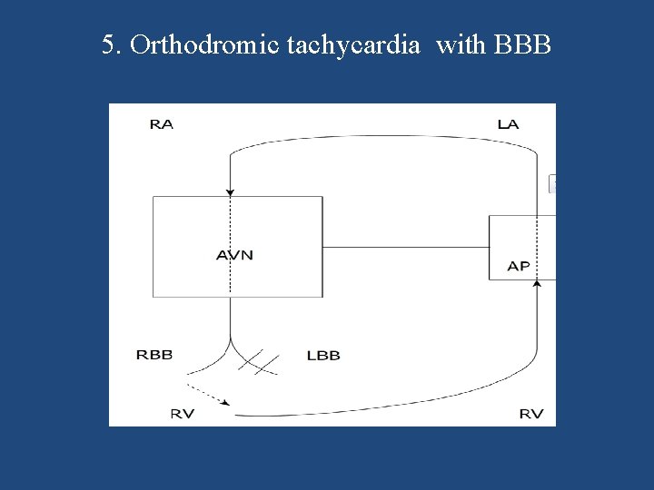 5. Orthodromic tachycardia with BBB 