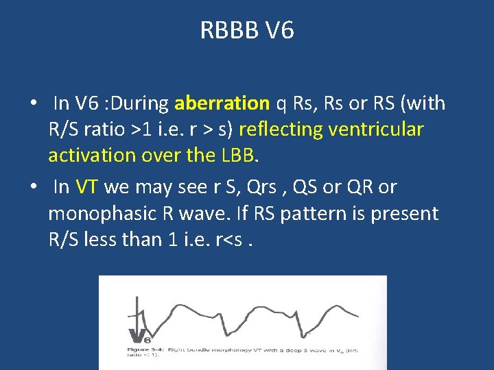 RBBB V 6 • In V 6 : During aberration q Rs, Rs or