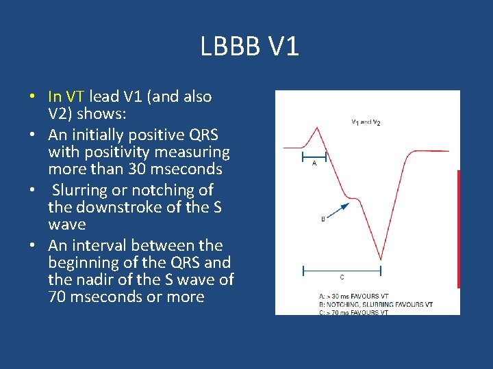 LBBB V 1 • In VT lead V 1 (and also V 2) shows: