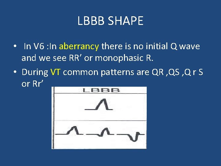 LBBB SHAPE • In V 6 : In aberrancy there is no initial Q