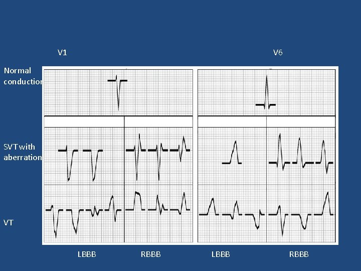 V 1 V 6 Normal conduction SVT with aberration VT LBBB RBBB 