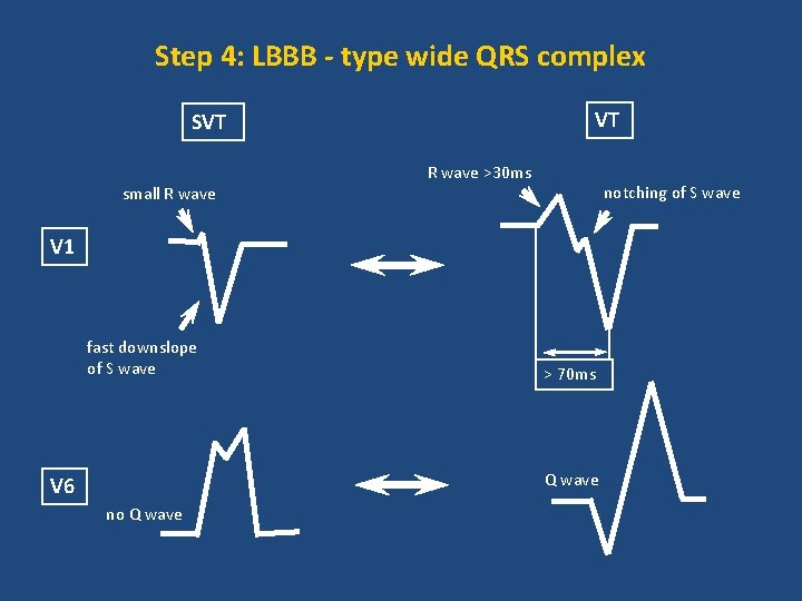 Step 4: LBBB - type wide QRS complex VT SVT small R wave >30