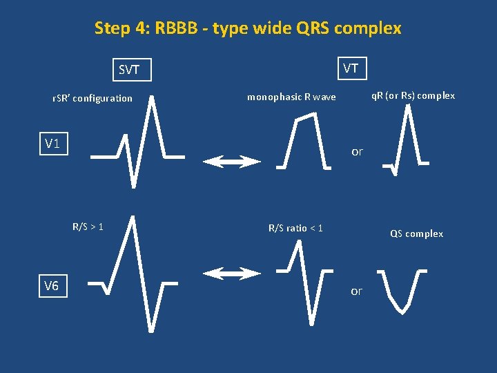 Step 4: RBBB - type wide QRS complex VT SVT r. SR’ configuration V