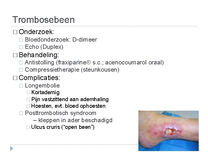 Trombosebeen � Onderzoek: Bloedonderzoek: D-dimeer � Echo (Duplex) � � Behandeling: Antistolling (fraxiparine® s.