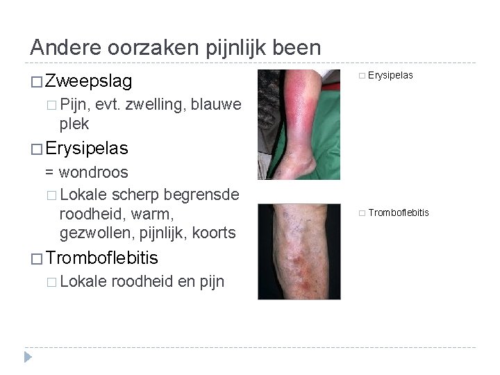 Andere oorzaken pijnlijk been � Zweepslag � Pijn, � Erysipelas � Tromboflebitis evt. zwelling,