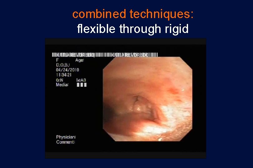 combined techniques: flexible through rigid 