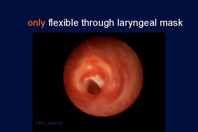 only flexible through laryngeal mask 