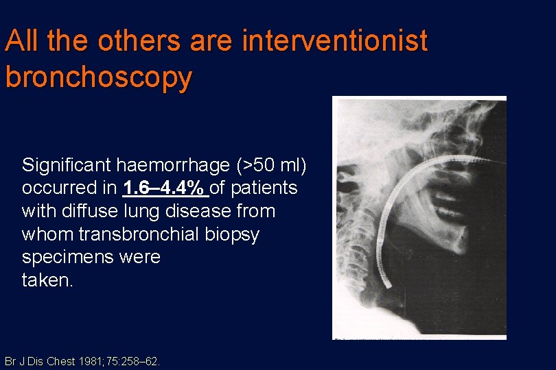All the others are interventionist bronchoscopy Significant haemorrhage (>50 ml) occurred in 1. 6–