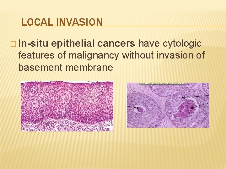 LOCAL INVASION � In-situ epithelial cancers have cytologic features of malignancy without invasion of