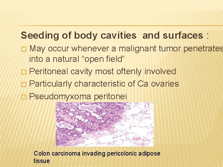 Seeding of body cavities and surfaces : May occur whenever a malignant tumor penetrates