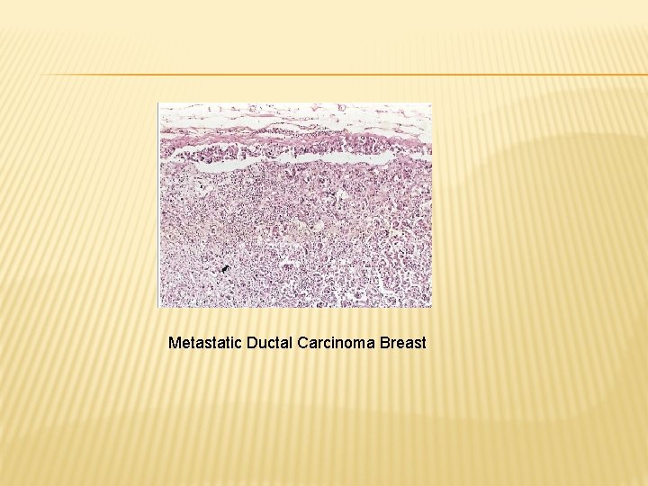 Metastatic Ductal Carcinoma Breast 