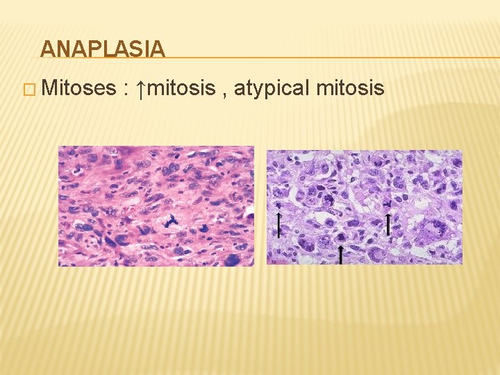 ANAPLASIA � Mitoses : ↑mitosis , atypical mitosis 