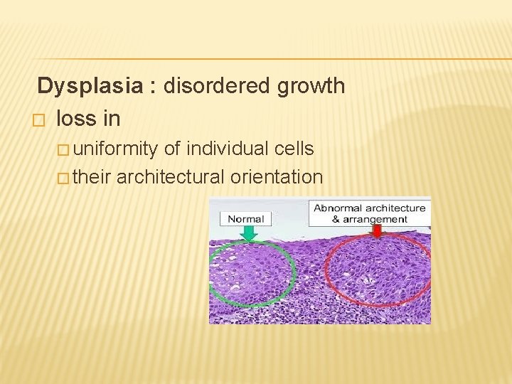 Dysplasia : disordered growth � loss in � uniformity of individual cells � their