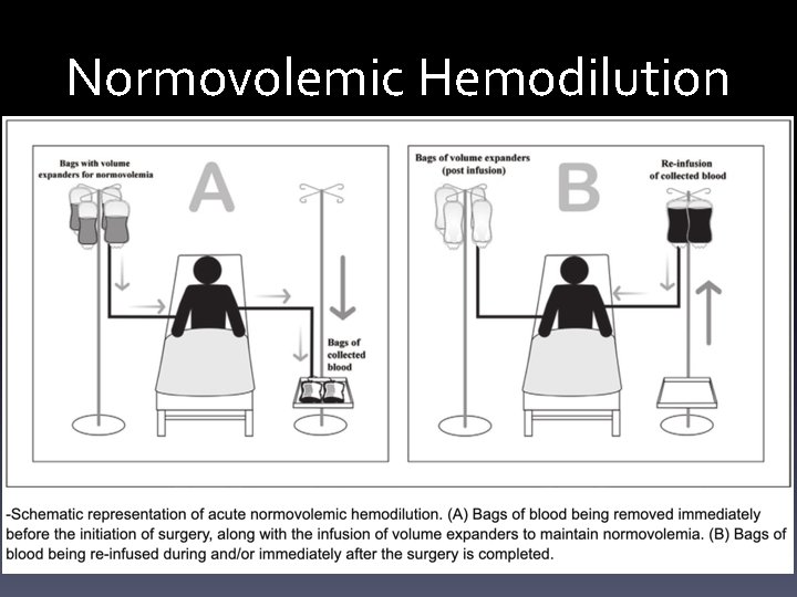 Normovolemic Hemodilution 