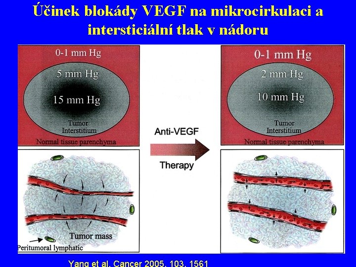 Účinek blokády VEGF na mikrocirkulaci a intersticiální tlak v nádoru Yang et al. Cancer