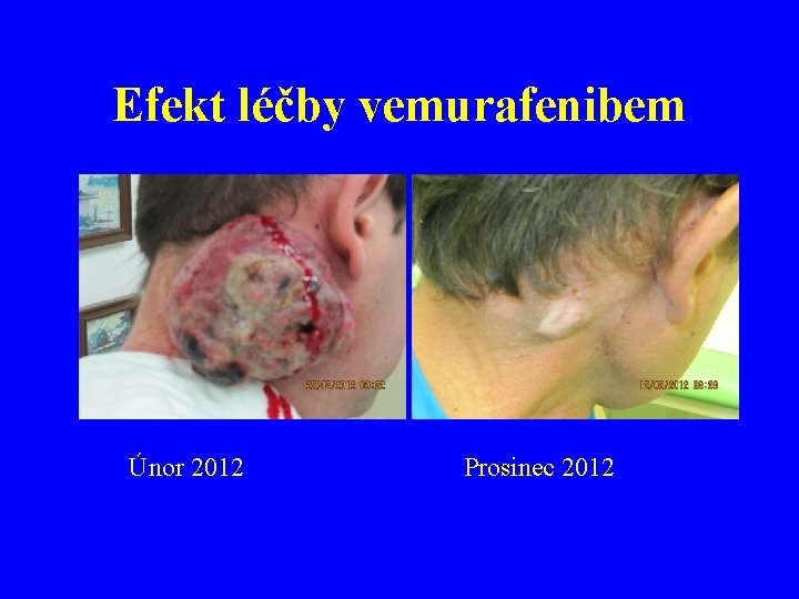 Efekt léčby vemurafenibem Únor 2012 Prosinec 2012 