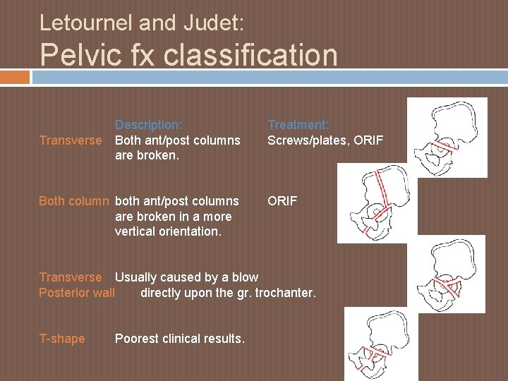 Letournel and Judet: Pelvic fx classification Transverse Description: Both ant/post columns are broken. Both