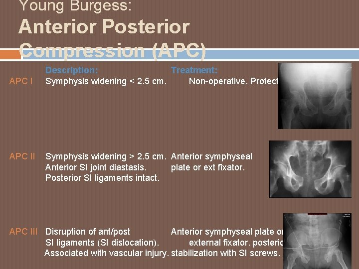 Young Burgess: Anterior Posterior Compression (APC) APC II Description: Treatment: Symphysis widening < 2.