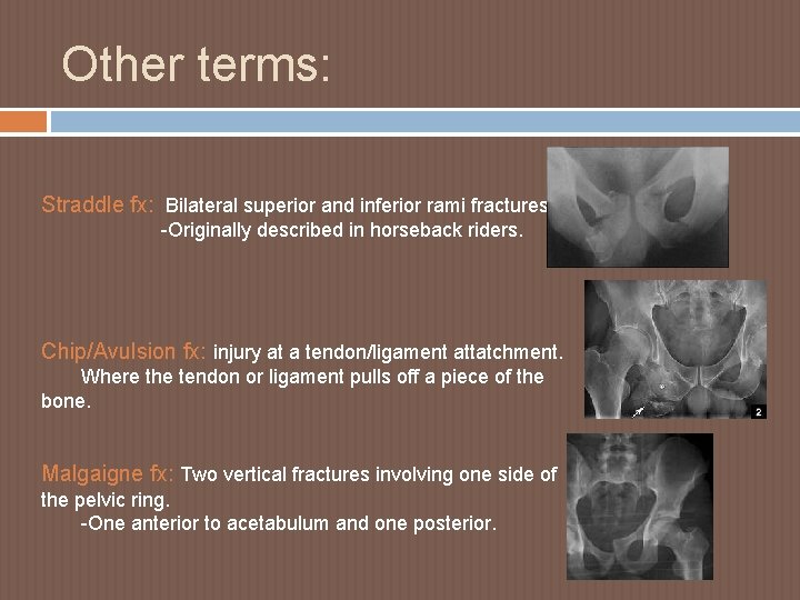 Other terms: Straddle fx: Bilateral superior and inferior rami fractures. -Originally described in horseback