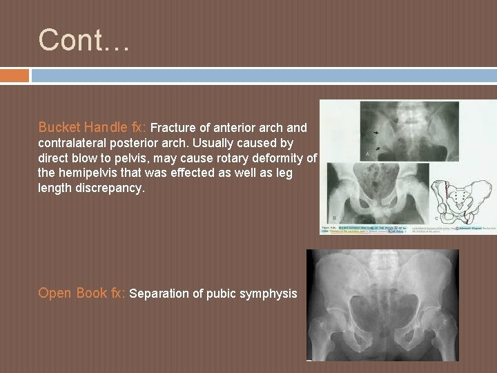 Cont… Bucket Handle fx: Fracture of anterior arch and contralateral posterior arch. Usually caused