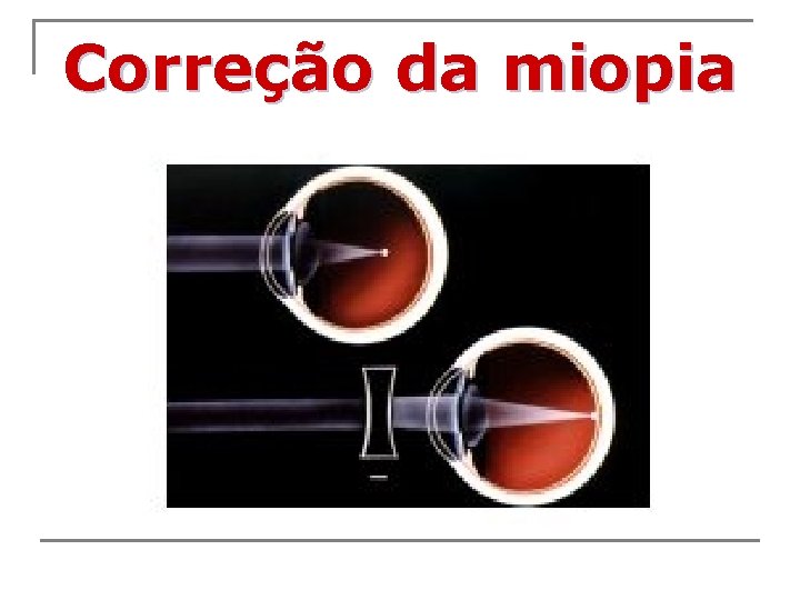 Correção da miopia 