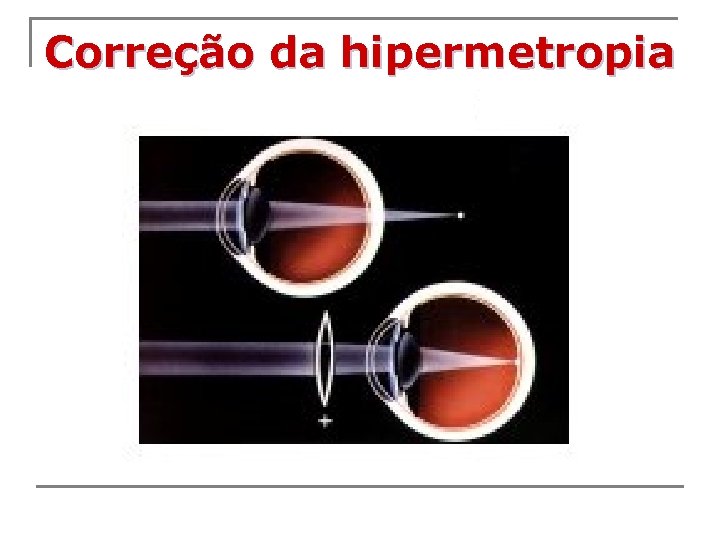 Correção da hipermetropia 