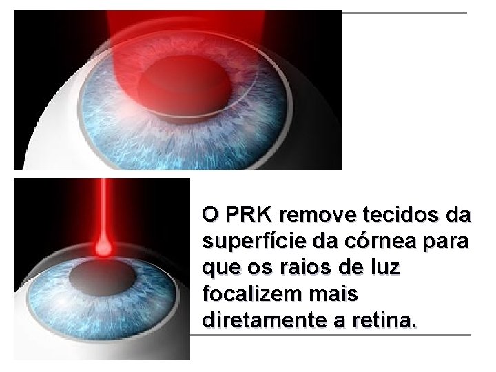 O PRK remove tecidos da superfície da córnea para que os raios de luz