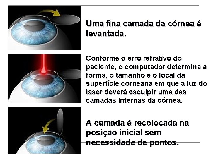 Uma fina camada da córnea é levantada. Conforme o erro refrativo do paciente, o