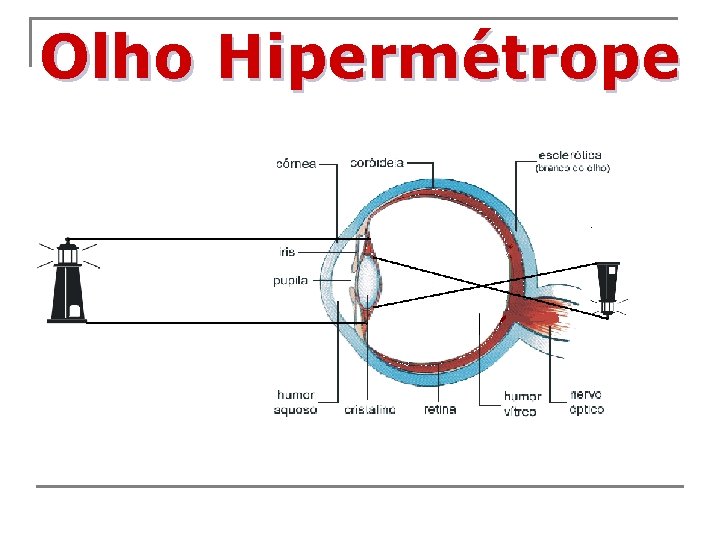 Olho Hipermétrope 