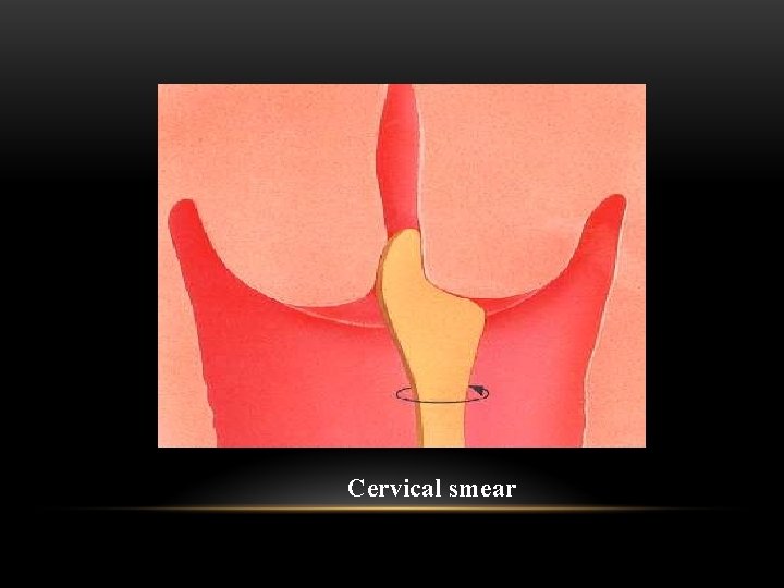 Cervical smear 