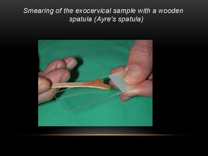 Smearing of the exocervical sample with a wooden spatula (Ayre's spatula) 
