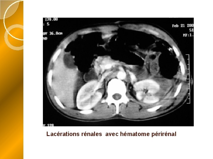 Lacérations rénales avec hématome périrénal 