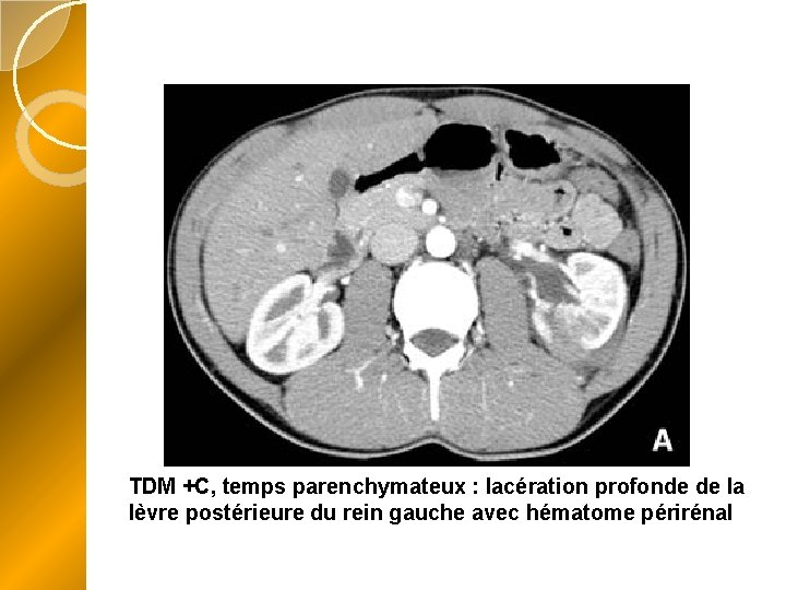 TDM +C, temps parenchymateux : lacération profonde de la lèvre postérieure du rein gauche