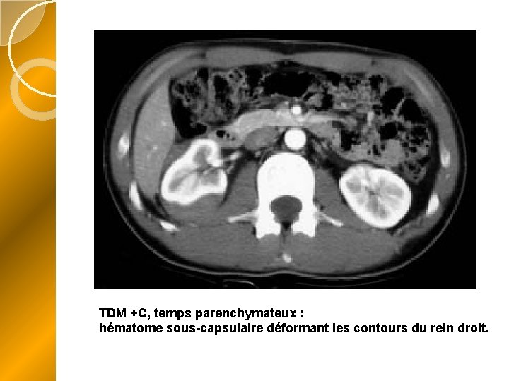 TDM +C, temps parenchymateux : hématome sous-capsulaire déformant les contours du rein droit. 