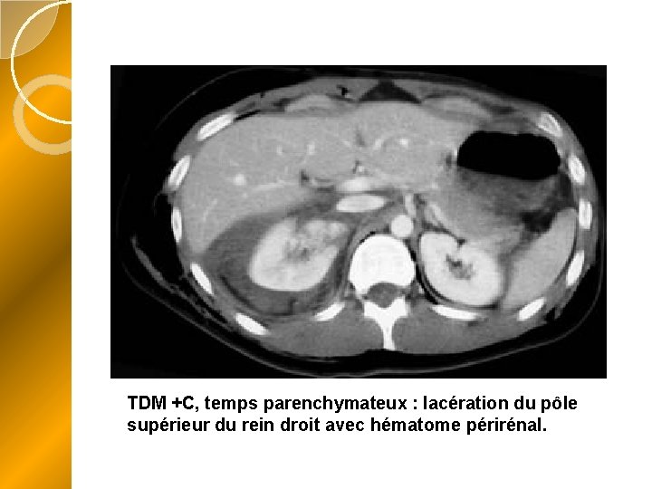 TDM +C, temps parenchymateux : lacération du pôle supérieur du rein droit avec hématome
