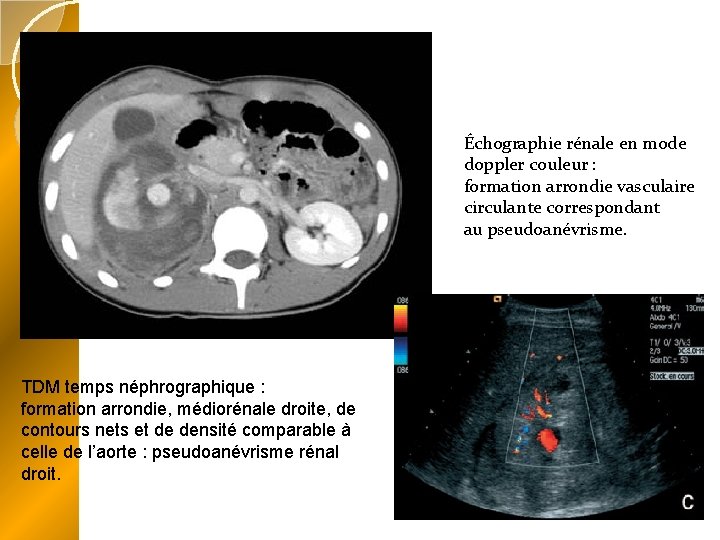 Échographie rénale en mode doppler couleur : formation arrondie vasculaire circulante correspondant au pseudoanévrisme.