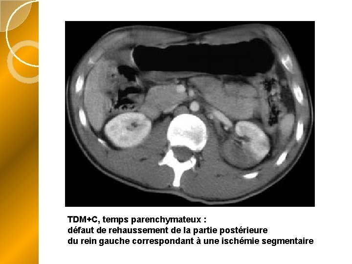 TDM+C, temps parenchymateux : défaut de rehaussement de la partie postérieure du rein gauche