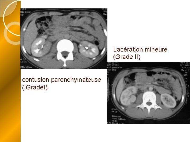 Lacération mineure (Grade II) contusion parenchymateuse ( Grade. I) 