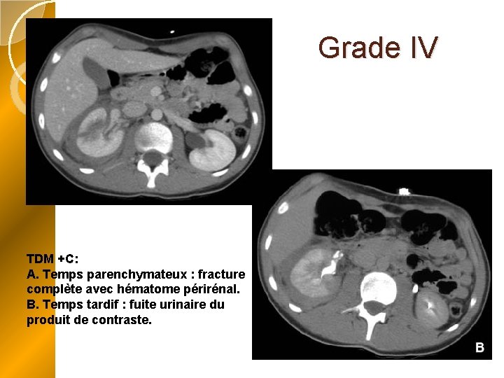 Grade IV TDM +C: A. Temps parenchymateux : fracture complète avec hématome périrénal. B.