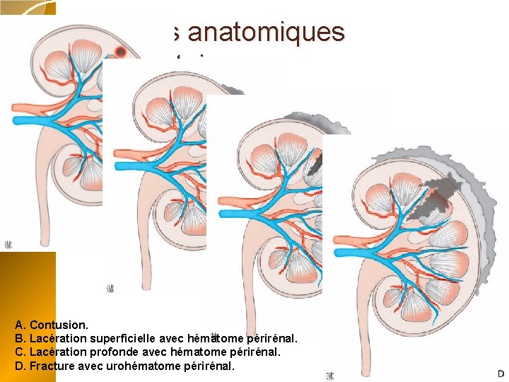 Lésions anatomiques élémentaires A. Contusion. B. Lacération superficielle avec hématome périrénal. C. Lacération profonde