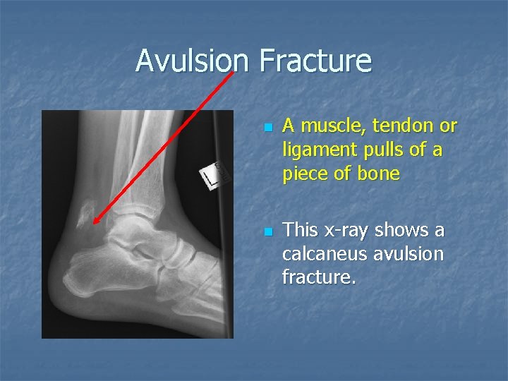 Evaluation Assessment Types of Fractures Bell Work n