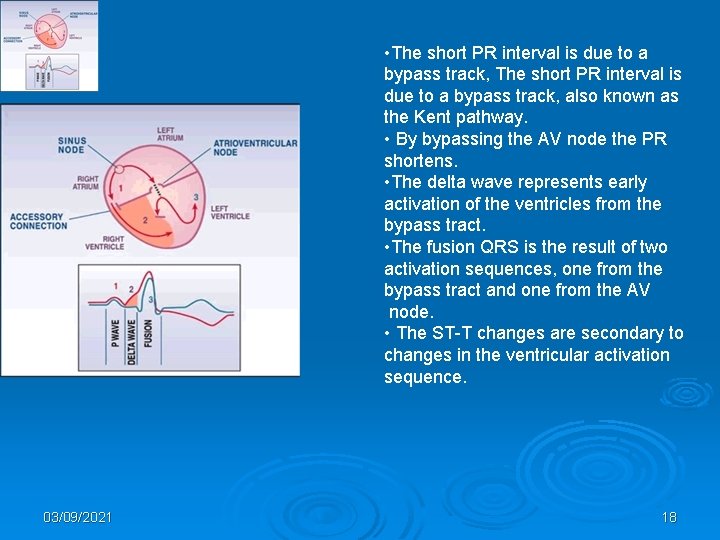  • The short PR interval is due to a bypass track, also known