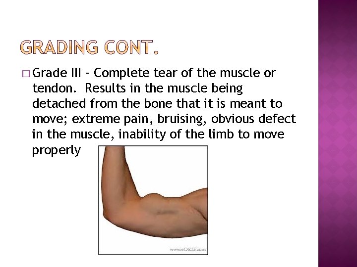 � Grade III – Complete tear of the muscle or tendon. Results in the