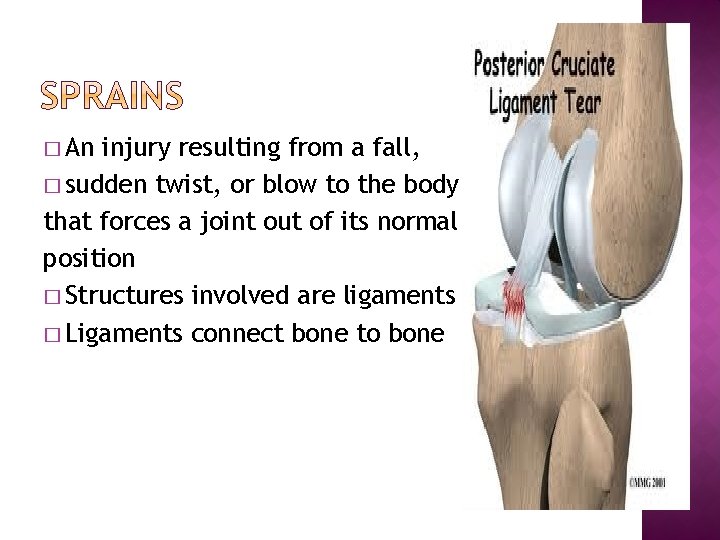 � An injury resulting from a fall, � sudden twist, or blow to the