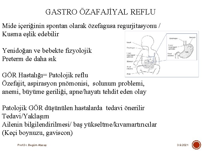 GASTRO ÖZAFAJİYAL REFLU Mide içeriğinin spontan olarak özefagusa regurjitasyonu / Kusma eşlik edebilir Yenidoğan