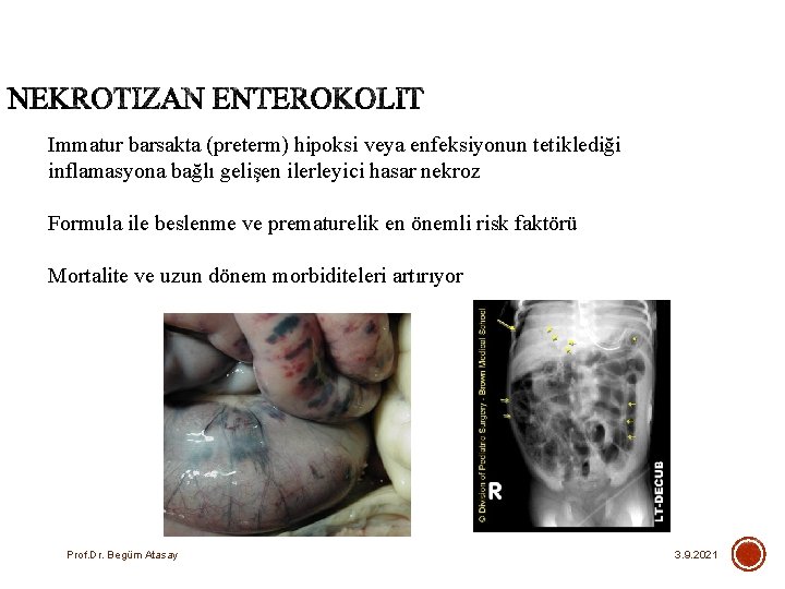 Immatur barsakta (preterm) hipoksi veya enfeksiyonun tetiklediği inflamasyona bağlı gelişen ilerleyici hasar nekroz Formula