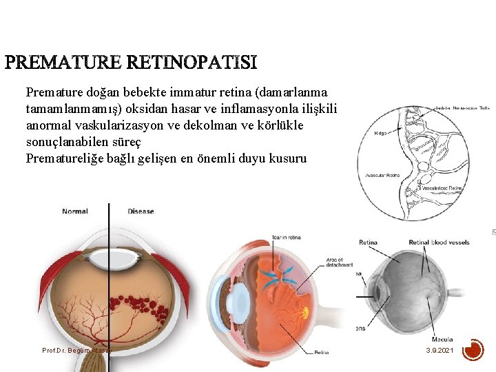 Premature doğan bebekte immatur retina (damarlanma tamamlanmamış) oksidan hasar ve inflamasyonla ilişkili anormal vaskularizasyon